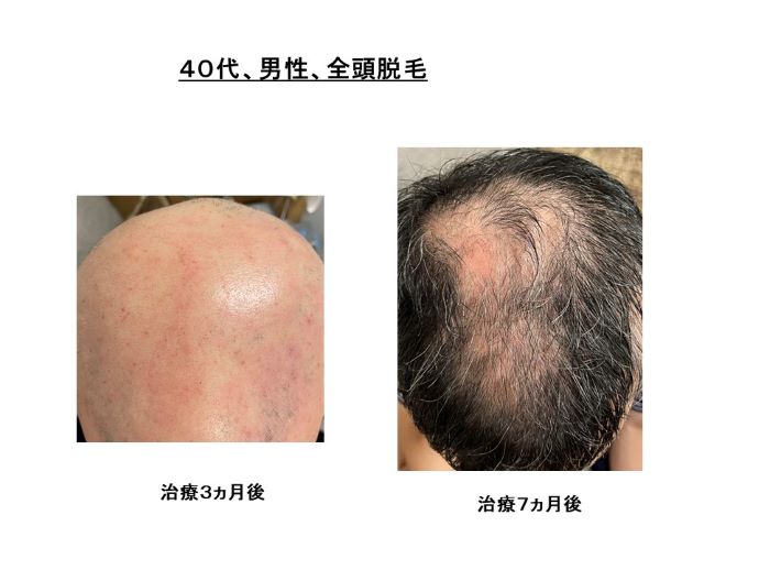 円形脱毛症　病院